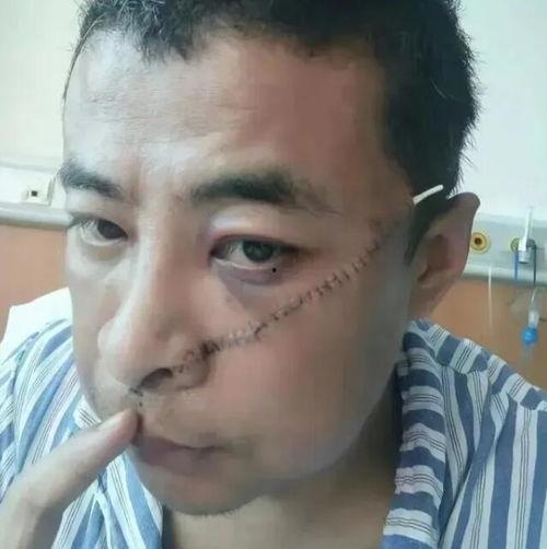 脸上的疤图片,探寻脸庞印记的深刻寓意