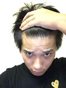 高发际线图片,探寻美丽背后的秘密